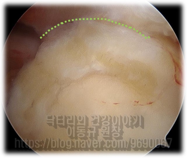 이두장건 절제술을 시행하고 너덜거리는 조직을 정리한 사진입니다.