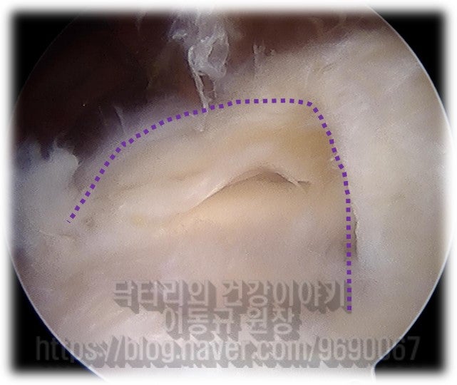 보라색 점선으로 표시된 부위가 파열된 회전근개 (극상근) 입니다. 다행이 힘줄의 퇴행성 변화가 심하지 않는 것이 관찰됩니다.