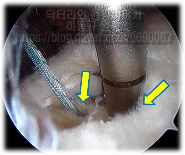 2개의 봉합나사를 상관골의 foot print 내측으로 삽입하는 사진입니다. 내측으로 삽입한 다음 봉합사를 파열된 회전근개 (극상근) 를 통과시켜 일차적으로 봉합한 상완골 외측으로 2개의 고정봉합나사를 이용하여 foot print 를 면으로 부착될 수 있게 봉합합니다.