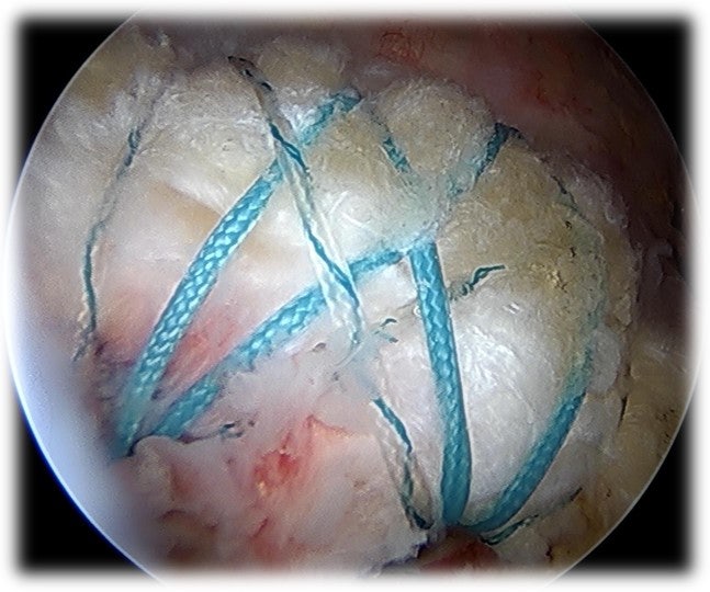 파열된 회전근개에 대해 이열봉합법으로 더 단단히 봉합된 사진입니다.