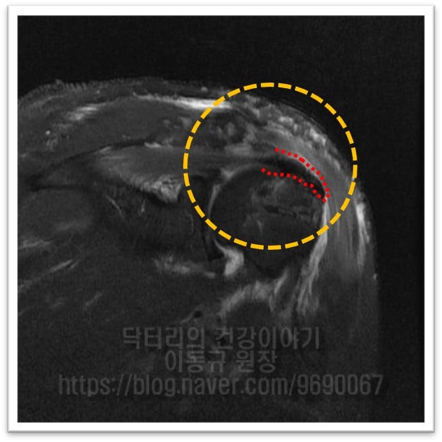 파열되었던 회전근개가 원래의 위치로 정확히 위치해 있는 것이 관찰됩니다.
