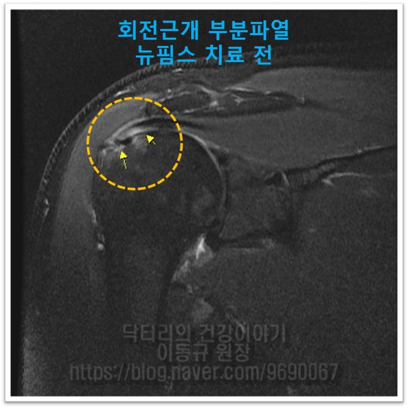 주황색 원안에 극상근이 부분적으로 파열되어 원래 MRI 상에서 검게 보여야 할 힘줄이 하얗게 보이며 뼈까지 염증이 있는 상태입니다.