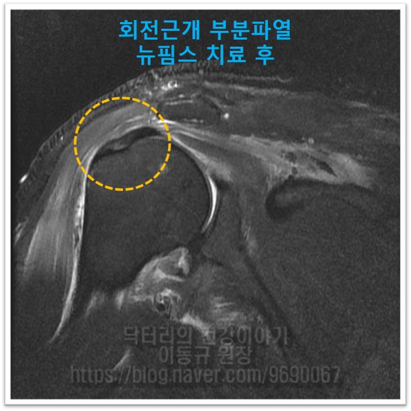 뉴핌스 치료 전 MRI 와 비료해 보면 회전근개의 상태가 검게 잘 보이며 아주 건강해 회복된 것이 보입니다.