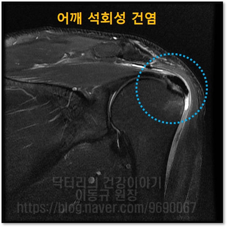 MRI 사진에서도 상당한 크기의 석회가 관찰되며 염증성 물들도 상당히 많이 고여 있는 것이 관찰됩니다.