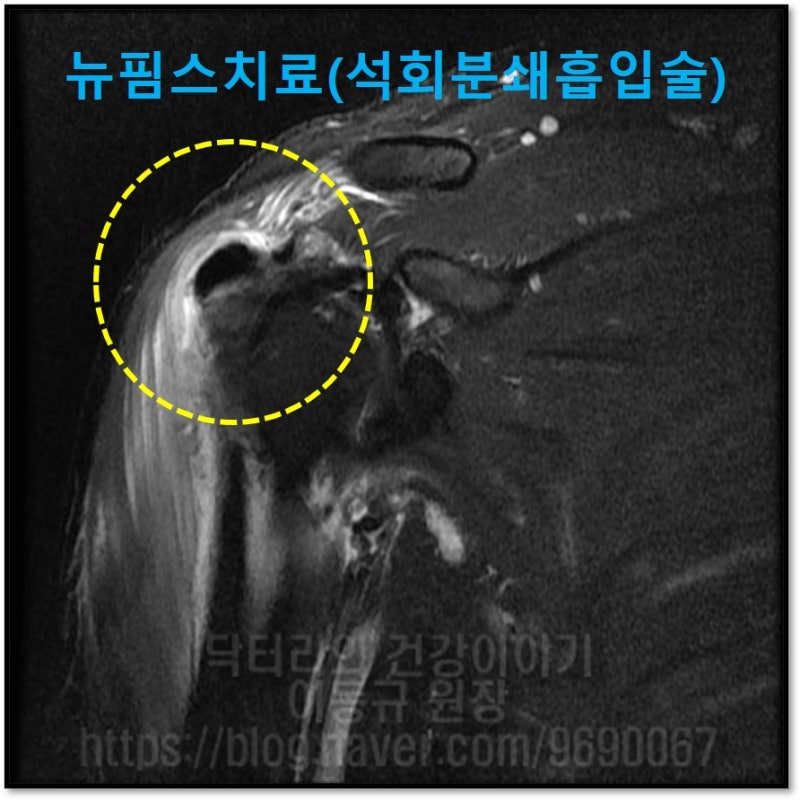 견갑하근의 상부에 노란 원안의 검은 것이 석회 입니다. 석회로 인한 염증으로 주위가 하얗게 변해있는 것이 관찰됩니다.