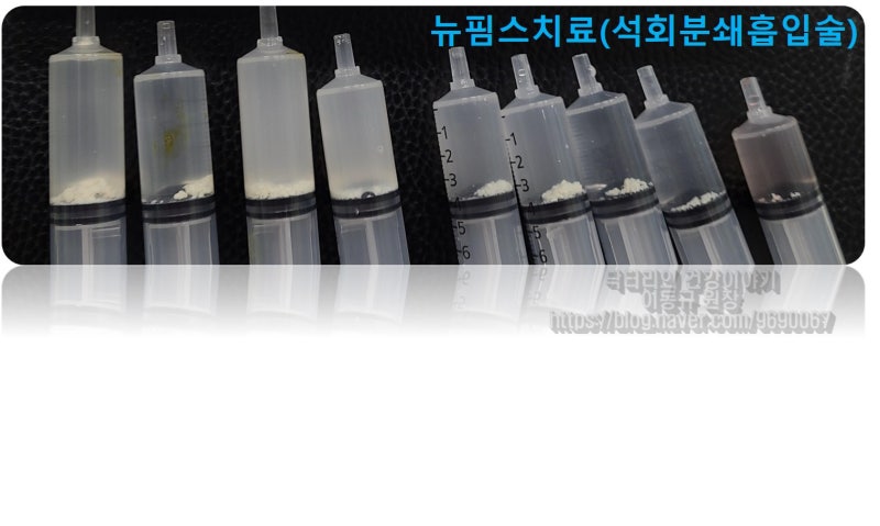 시술하고 나서 주사기에 하얗게 보이는 것이 석회를 분쇄하여 흡입한 것입니다.