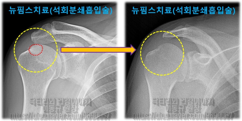 시술 후 X-ray 에서 석회가 거의 다 흡수된 것이 확인됩니다.