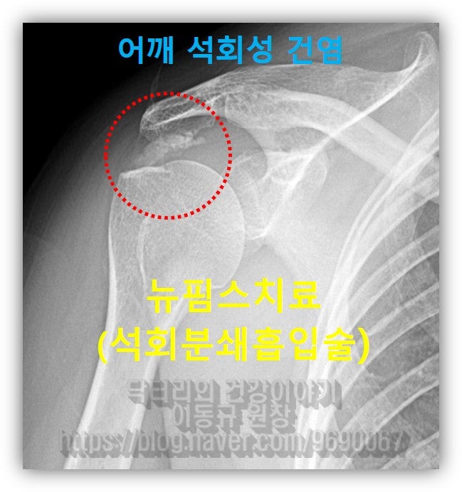 X-ray에서 빨간 원안에 하얗게 보이는 커다란 석회가 관찰됩니다.