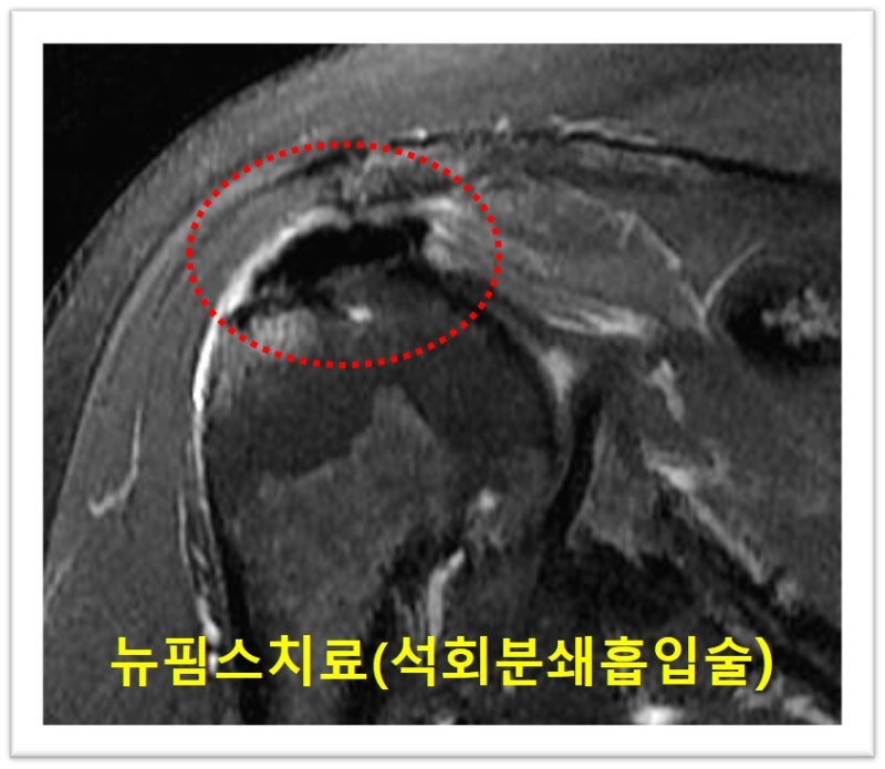 MRI 사진에서도 빨간 원안에 검게 보이는 것이 석회이며 주위로 염증성 반응으로 인한 하얀 물들이 관찰됩니다.