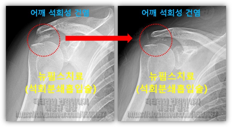 뉴핌스치료(석회분쇄흡입술) 후 X-ray를 비교해 보면 석회의 양이 확연하게 줄어든것이 관찰됩니다.