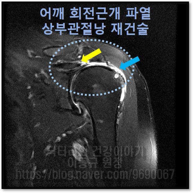 MRI 사진을 보면 파열된 회전근개가 위축이 되어 원래 파란 화살표에 있어야 할 힘줄이 노란 화살표까지 위축되어 말려들어간 것이 보입니다. 견갑와 까지 위축이 되어서 원래의 해부학적 위치로 복원하기가 불가능한 상태입니다.