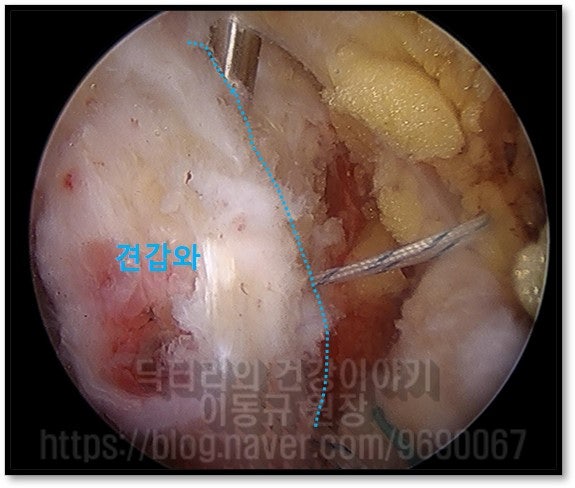 견갑와에 상부관절낭 재건술을 위한 봉합 나사를 삽입하는 사진입니다.