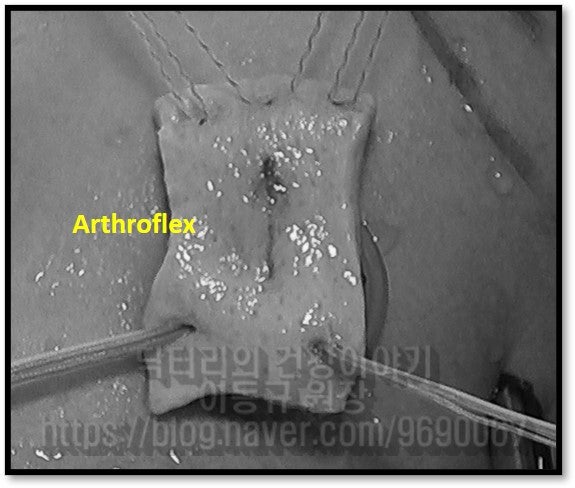 재건술에 사용한 힘줄을 준비한 사진입니다.