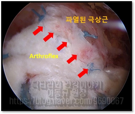 상부관절낭 재건술을 시행한 사진입니다. 이 환자의 경우 상부관절낭 재건술을 시행한 다음 위축된 회전근개(극상근)를 재건술에 사용된 힘줄에 연결해 주었습니다.(빨간 화살표)