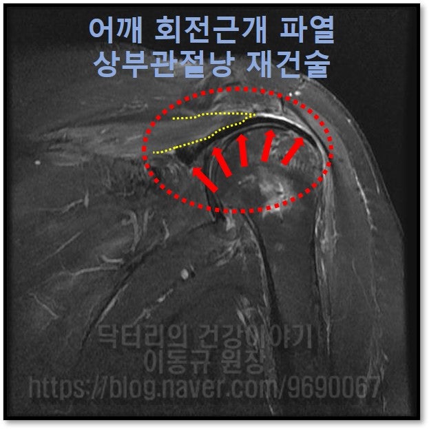 수술 후 3개월 MRI 를 보면 빨간 화살표로 표시된 검은 것이 상부관절낭 재건술을 한 힘줄입니다. 견갑와에서 부터 상완골 대결절까지 완벽하게 해부학적으로 복원된 것이 관찰됩니다. 또한 노란 점선으로 표시된 것이 파열된 극상근을 재건술에 사용된 힘줄에 봉합한 것인데 이 또한 더이상 근육의 위축이나 퇴행성 변화가 진행되지 않고 제 기능을 하는 것이 관찰됩니다.