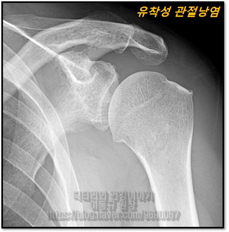 X-ray 상에서는 상완골 대결절 극상근 부착 부위에 미세한 석회와 골극이 자라난 것이 관찰됩니다.