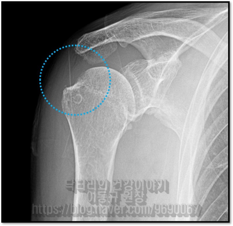 X-ray 사진에서 파란 원으로 표시된 부위가 회전근개가 붙는 위치인데 약간의 석회와 뼈의 경질화 현상이 관찰됩니다.