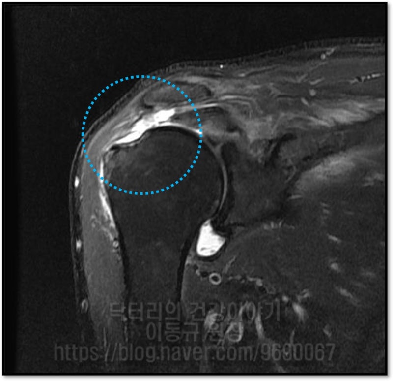 MRI 영상을 보면 파란 원 안에 회전근개(극상근)이 완전히 파열되어 없어진 것을 볼수 있습니다.