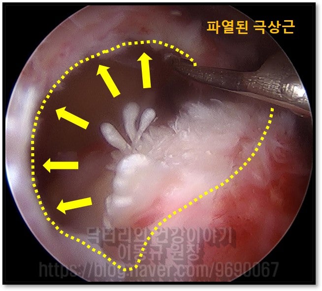관절경 사진상 회전근개(극상근)이 완전이 파열되어 상완골의 부착부에서 완전히 떨어진 것이 관찰됩니다.
