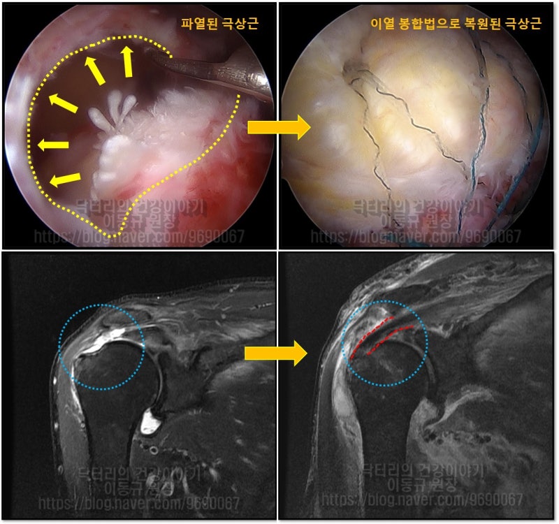 사진을 비교하여 관찰하면 관절경 사진에서도 완전히 파열된 극상근이 완벽하게 봉합되었으며 MRI 상에서도 파열된 극상근이 해부학적으로 완벽히 복원된 것이 관찰됩니다.