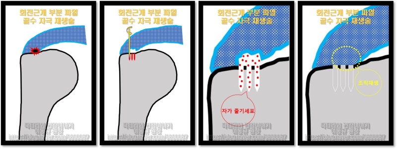 회전근개 부분파열이 있는 경우 초음파를 이용하여 정확하게 파열 부위의 상완골에 작은 구멍을 만듭니다. 그렇게 되면 작은 구멍에서 골수세포들이 나오게 되며 이러한  자가줄기세포를 통해 조직의 치유를 하는 치료법 입니다.