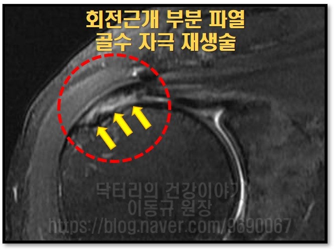 검사한 MRI 에서 검게 표시되어야 할 회전근개가 노란색 화살표로 표시된 것 처럼 햐얗게 보이며 갈라져 보이는 부분 파열이 관찰됩니다. 꽤 심한 정도로 파열이 진행된 것이 관찰됩니다.