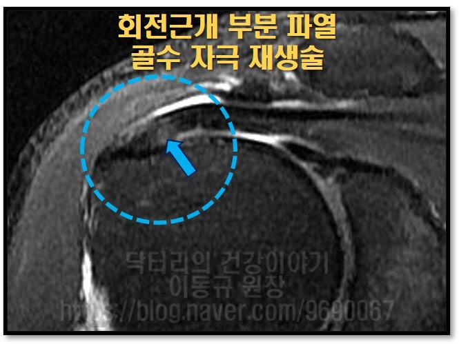 이전에 회전근개 부분파열이 되어 하얗게 갈라져 있던 것이 정상에 가깝게 회복된 것이 관찰됩니다.