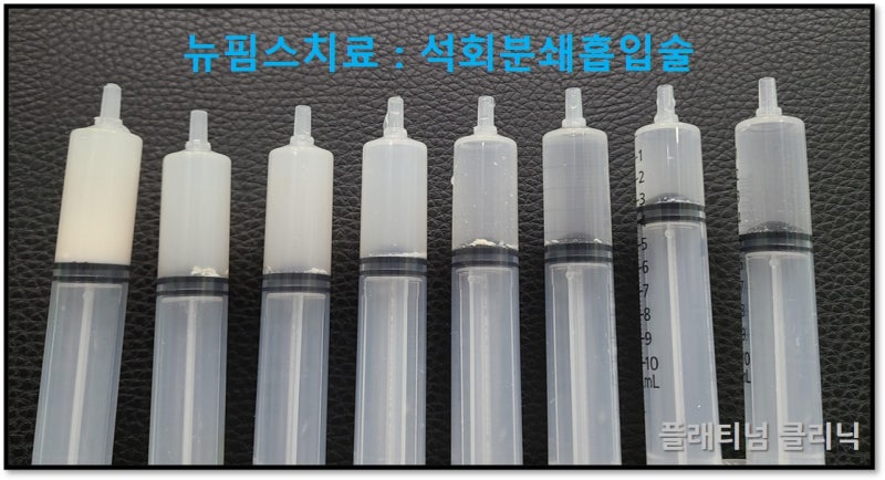 투명한 액체로 시작한 주사기가 하얗고 뿌옇게 변하고 주사기 아래쪽으로 침착된 석회가 관찰됩니다.