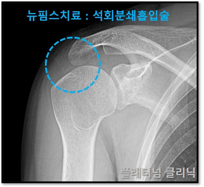 시술 후 파란 원안에 석회가 거의 없어진 것이 확인됩니다.