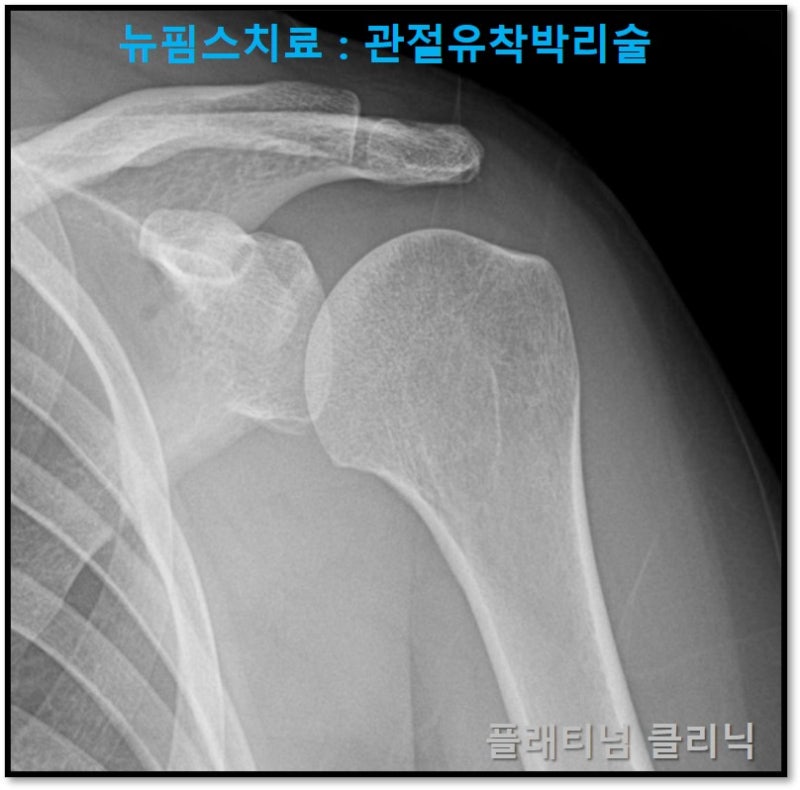 X-ray  상에서는 특이소견이 없었습니다.