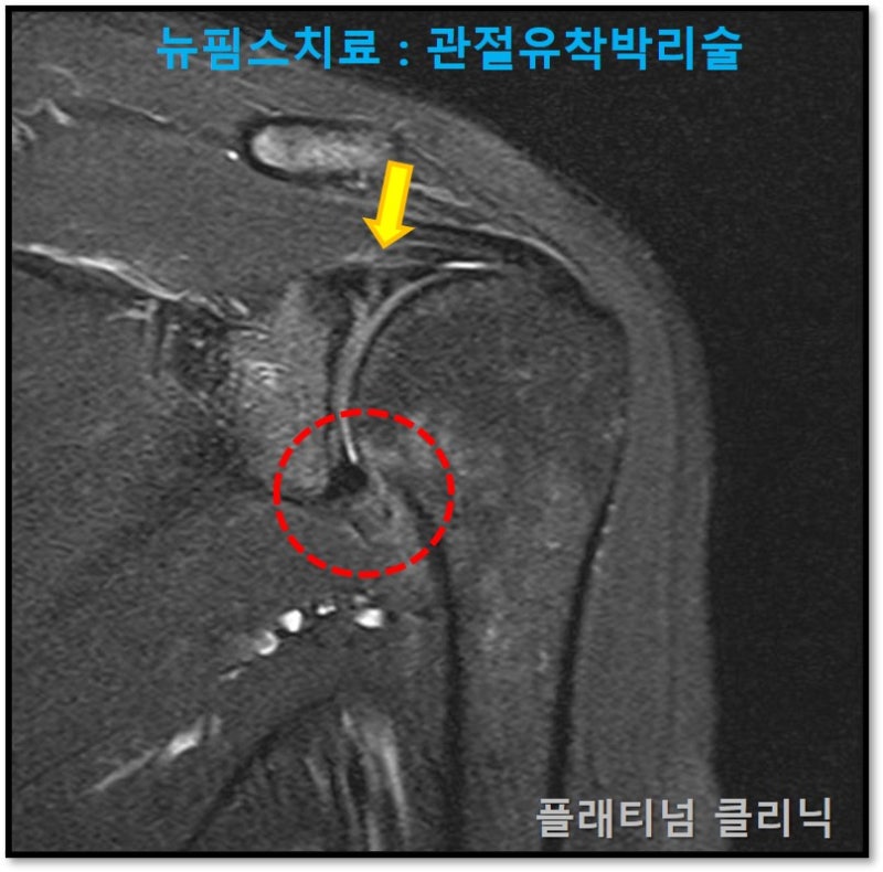MRI 상에서는 빨간 원안에 하방 관절낭이 유착된 전형적인 오십견 소견이 보이고 있습니다. 그런데 노란 화살표 부위에 상부관절와순이 약간 손상되어 있는 것이 확인되었습니다.