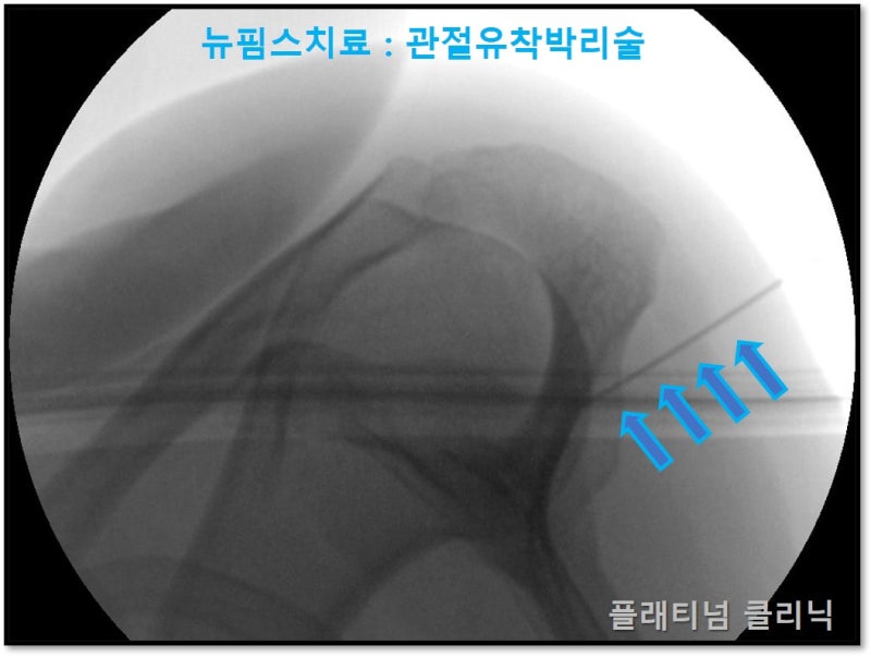 특수 침을 이용하여 근막 및 관절낭 유착을 풀어주는 시술을 진행하였습니다.