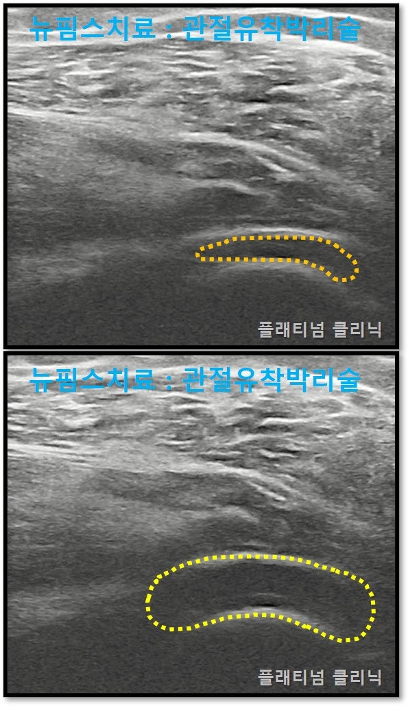 관절유착박리술을 통해 초음파상 관절낭이 넣어진 것을 확인할 수 있습니다.