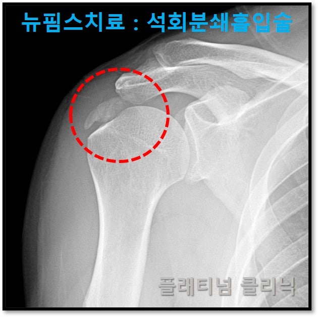 빨간 원안에 커다란 석회가 관찰됩니다.