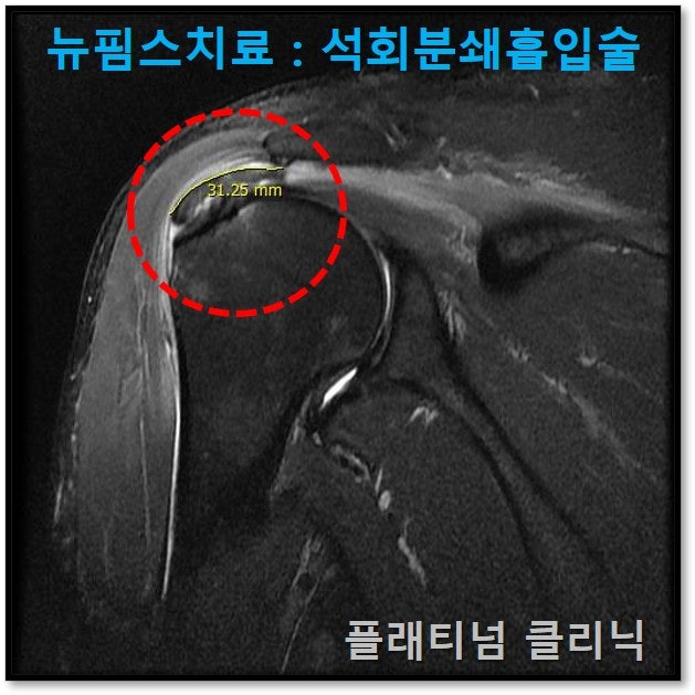 MRI 상에서도 극상근 힘줄 내에 약 3.1cm  크기의 석회가 관찰되여 하방관절낭 유착까지 관찰됩니다.