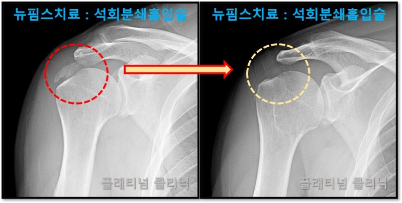 치료 후 사진을 비교하면 빨간 원안에 있던 석회가 노란 원안에는 거의 없는 것이 확인됩니다.