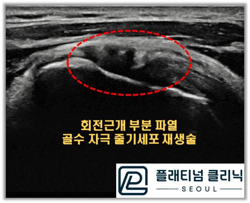 초음파 사진을 보면 빨간 원안에 원래는 하얗게 회전근개가 채워져 있든 보여야 하는데 검게 보이는 부위가 부분적으로 파열된 회전근개가 관찰됩니다.