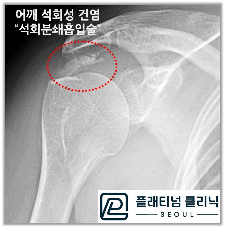 X-ray 에서 보면 빨간 원안에 상완골 위로 하얗게 보이는 석회가 관찰됩니다. 상당히 큰 크기의 석회가 관찰됩니다.