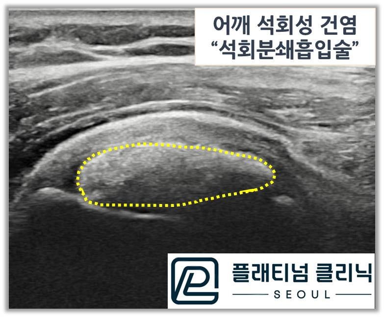 회전근개 내에 노란 점선으로 보이는 것이 석회 입니다. 이렇게 초음파 상에서 석회의 모양이 잘 보이는 경우에는 석회가 찐득찐득한 양상일 가능성이 매우 높습니다. 이러한 석회는 뽑혀져 나올때 치약처럼 보일 가능성이 많습니다.