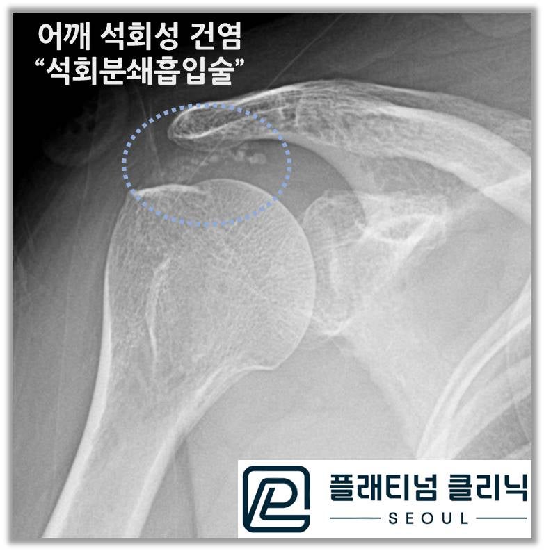 이전 빨간원안에 있던 석회가 파란원안에 보면 거의 다 없어진 것이 관찰됩니다.
