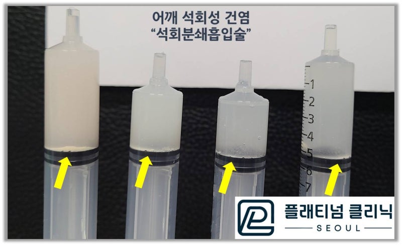 시술 후 찍은 주사기를 보면 맑았던 주사니 내부가 뿌옇게 변해 있으며 아래쪽으로 침착된 하얀 석회가루가 관찰됩니다.