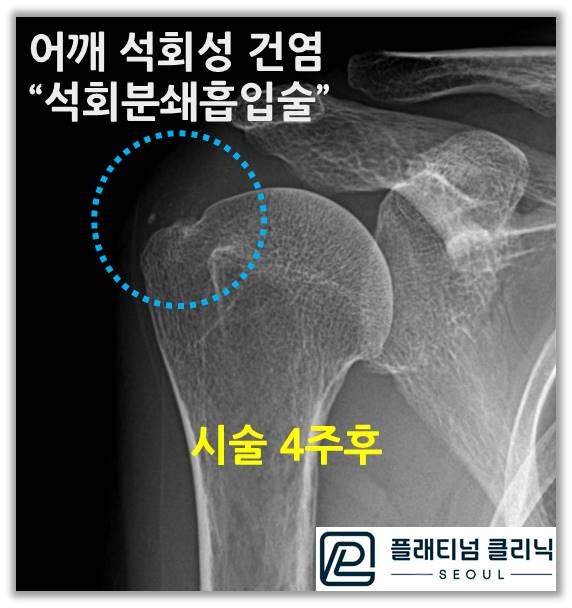 4주후 x-ray 사진에서 석회가 거의 없어진 것이 관찰됩니다.