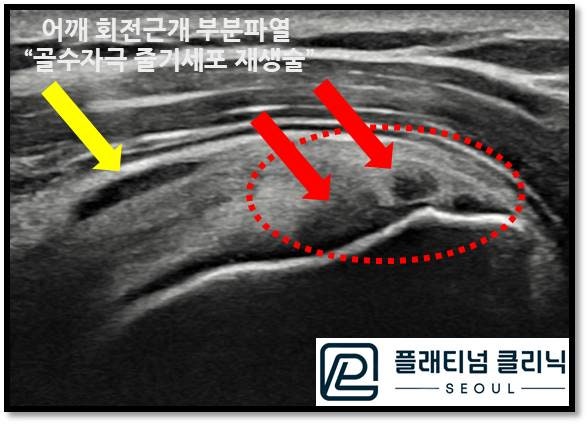 초음파에서는 정상 회전근개가 하얗게 보이며 빨간 원안에 검게 보이는 부위가 회전근개가 부분파열이 된 부위입니다. 노란 화살표로  표시된 부위는 파열로 인한 염증으로 염증성 물이 고여있는 것이 관찰됩니다.