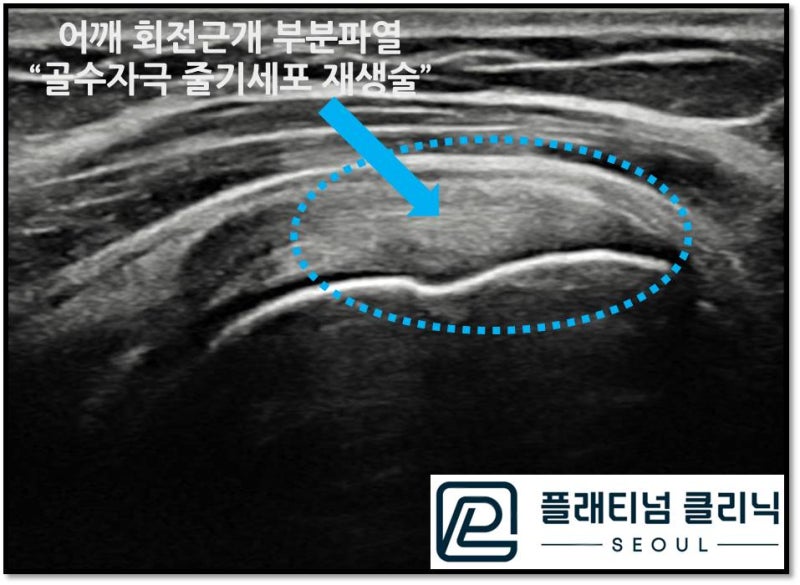 시술 후 6주차에 검사한 초음파 영상에서 이전에 검게 보이던 회전근개 손상 부위가 정상적으로 회복된 것이 관찰됩니다.