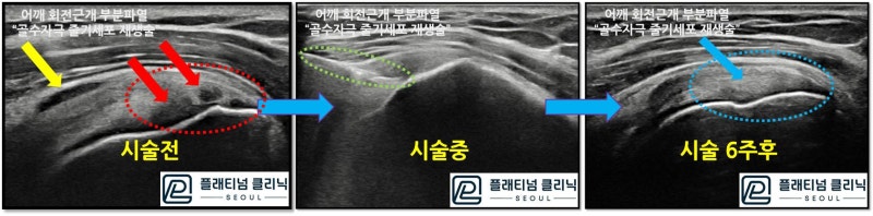 전체적으로 비교를 해 보면 가장 왼쪽에 있는 초음파 영상에서 빨간 원안에 검게 손상된 회전근개가 시술 6주후 초음파 영상에서 보면 검게 보이는 부위 없이 하얗게 정상적으로 회복된 것이 관찰됩니다.
