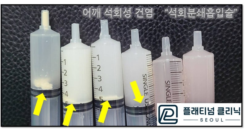주사기 않을 보시면 하얗게 보이는 것이 석회입니다. 환자분은 약간 치즈같은 석회도 있었고 분필가루같은 단단한 석회도 같이 있었습니다.