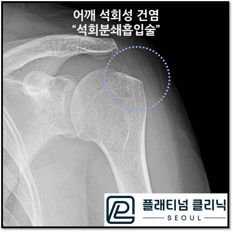 파란 원안을 보시면 이전 빨간 원안에 있던 커다란 석회가 거의 없어진 것이 확인됩니다.