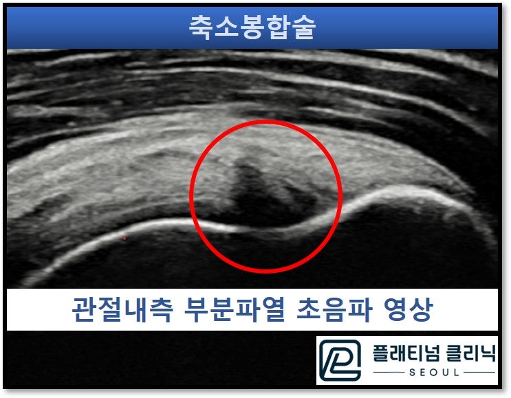 초음파 사진상 빨간 원안에 검게 보이는 부위가 회전근개 관절내측으로 부분파열이 발생된 것이 관찰됨.