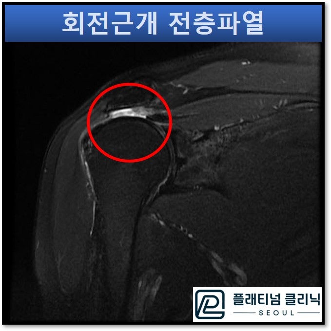 극상근 전층파열이 관찰되는 MRI 영상
