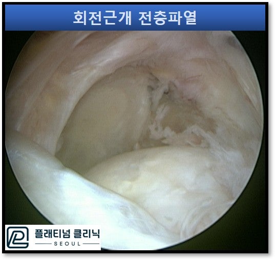 극상근이 전층파열이 되면서 위측이 진행된 관절경 사진